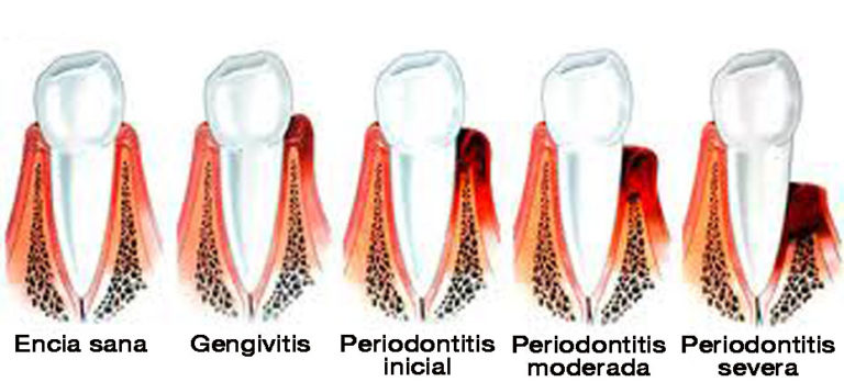 Una periodontitis avanzada sinónimo de diabetes mal controlada