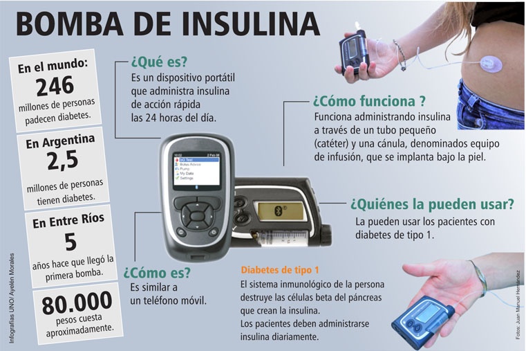 La bomba de insulina cambia la vida a personas con diabetes (Argentina)