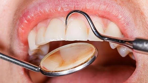 Identificado el mecanismo por el que la diabetes provoca la periodontitis