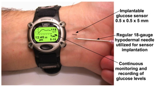 Un microchip para controlar la glucosa: glucowizzard