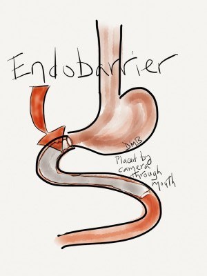 GI Dynamics suspende el marcado CE de EndoBarrier, su dispositivo endoscópico para la diabetes
