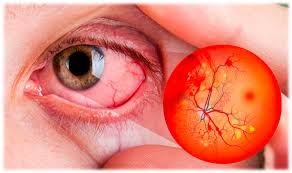 Celulas madre logran reparar daños ocasionados por la retinopatÍa diabética