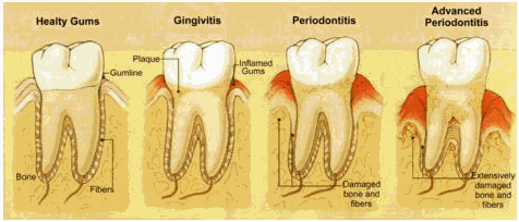 La periodontitis podría ser un signo precoz de una diabetes no diagnosticada