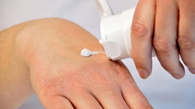 Cuidado de la piel seca en personas con diabetes