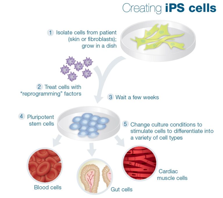 Trasplante de células con nueva técnica IPS ¿Posible cura para la diabetes tipo 1?